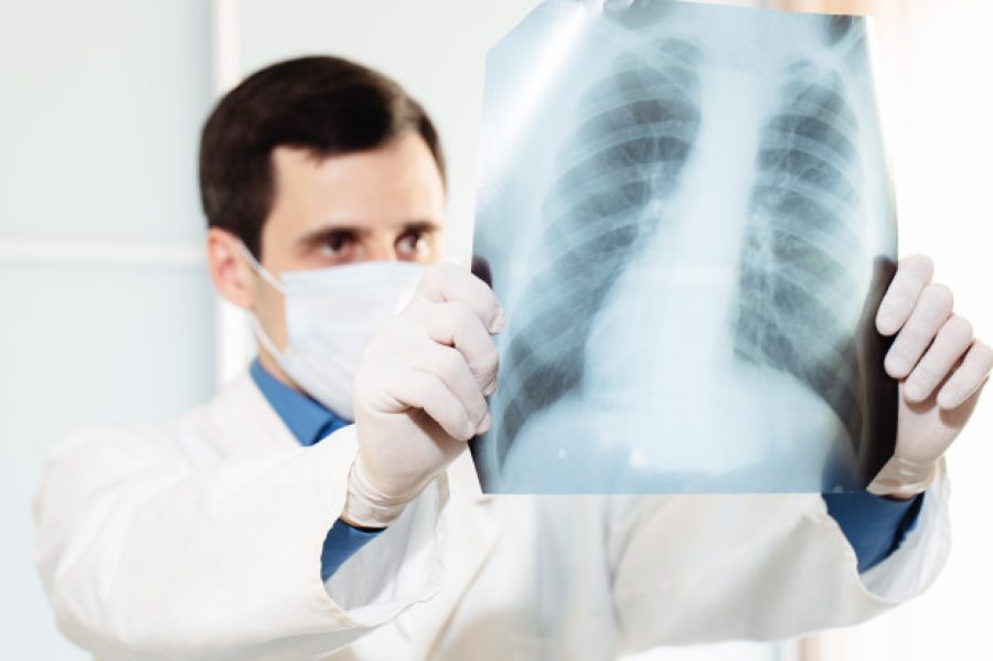Salud: ¿Cómo una radiografía puede ayudar al diagnóstico de COVID-19?